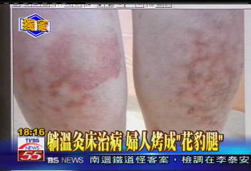 躺溫灸床治病 婦人烤成「花豹腿」