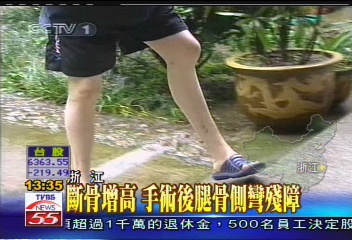 斷骨增高 手術後腿骨側彎殘障