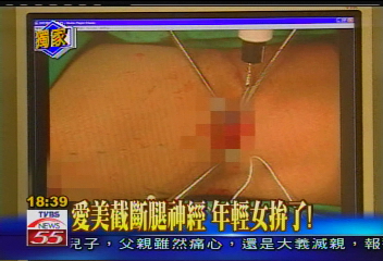 〈獨家〉瘦蘿蔔腿新招 花8萬斬斷小腿神經