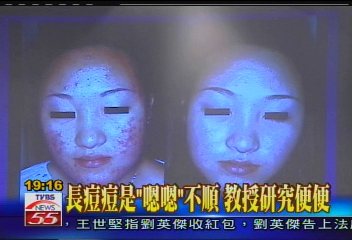 長痘痘是「嗯嗯」不順　教授研究便便