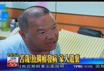 苦哉!魚鱗癬發病家人遺棄救助方式?