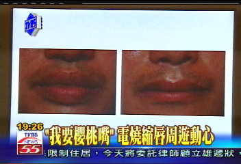 「我要櫻桃嘴」 電燒縮唇周遊動心