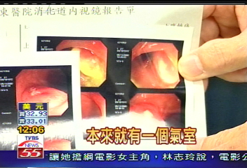 大腸水療導致結腸破 6旬老婦亡