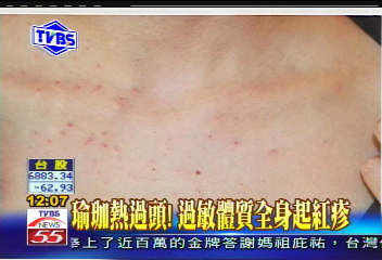 〈獨家〉瑜珈熱過頭! 過敏體質全身起紅疹