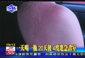 〈獨家〉喝膠原蛋白飲品　婦人長疹像乳牛