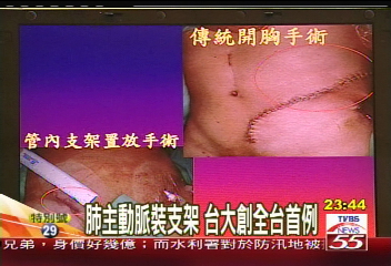 肺主動脈裝支架　台大創全台首例