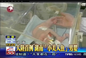 大陸首例 湖南「小美人魚」男嬰