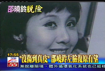 搶救邵曉鈴／「沒傷到真皮」　 邵曉鈴左臉復原有望