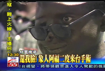 還我臉！　象人阿福二度來台手術