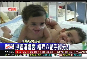 沙國連體嬰　禮拜六動手術分割