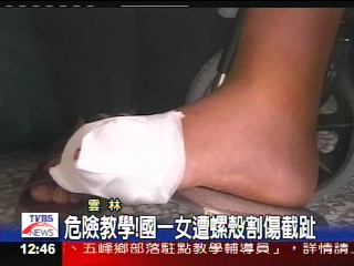 危險教學! 國一女遭螺殼割傷截趾