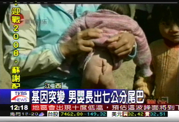 基因突變　男嬰長出7公分尾巴