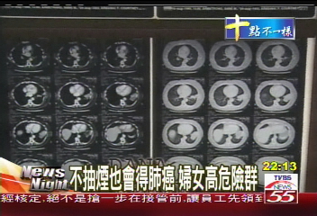 不抽煙也會得肺癌 婦女高危險群
