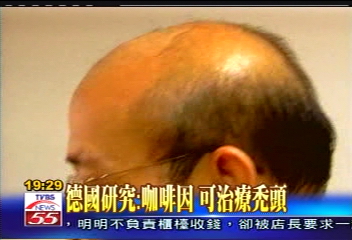 德國研究：咖啡因　可治療禿頭
