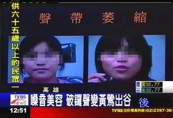 聲帶壞! 大學女「破鑼嗓」損自信