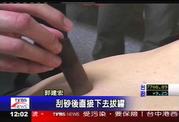 罐拔骨刺？　「神醫」被指控詐財