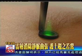 雷射消除靜脈曲張 護士趨之若鶩