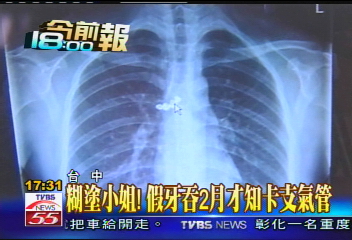 糊塗小姐！　假牙吞2月才知卡支氣管