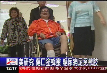 美研究　傷口塗蜂蜜　糖尿病足免截