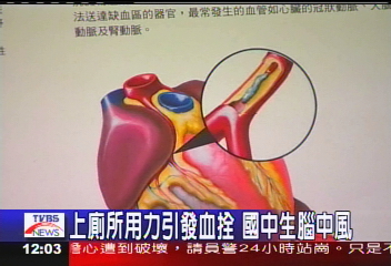 上廁所用力引發血拴　國中生腦中風