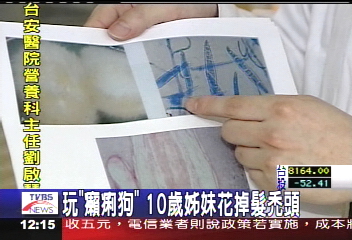 玩「癩痢狗」 10歲姊妹花掉髮禿頭