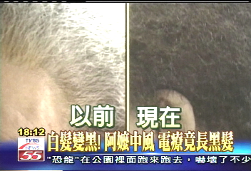 白髮變黑!阿嬤中風 電療竟長黑髮