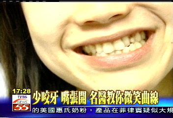 少咬牙、嘴張開 名醫教你微笑曲線