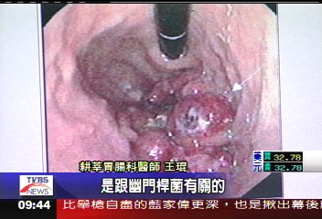 胃癌致病因子 幽門桿菌作祟