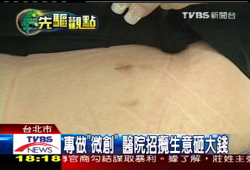 縮小手術疤　醫院推「微創中心」