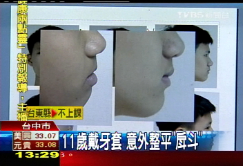 11歲戴牙套　意外整平「戽斗」