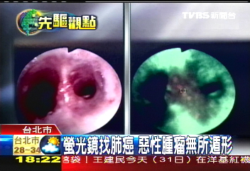 螢光鏡找肺癌　惡性腫瘤無所遁形