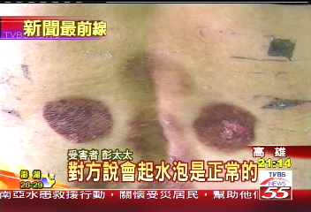 貼膏藥灼傷? 婦控民俗療法傷人