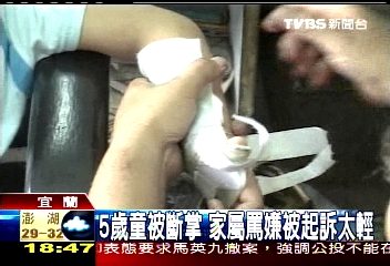 5歲童被斷掌　家屬罵嫌被起訴太輕