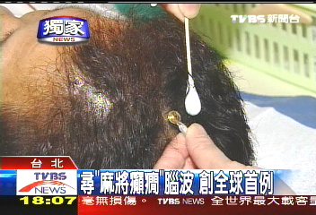 〈獨家〉尋「麻將癲癇」腦波　創全球首例