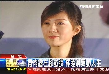 骨肉瘤左腳截肢 林睦卿舞動人生