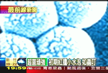 病菌奪命／超級病菌　抗藥性金黃色葡萄球菌