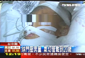 球門壓男童　氣切管戴到20歲