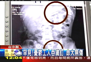 罕見!憂鬱工人吞鐵釘 命大無傷
