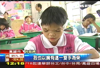 卸下鐵架 鐵面女孩變臉成功