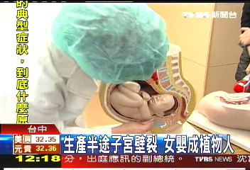 生產半途子宮壁裂 女嬰成植物人
