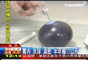 胃內「水球」減肥　半年瘦11公斤