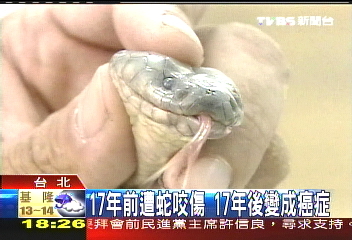 17年前遭蛇咬傷 17年後變成癌症