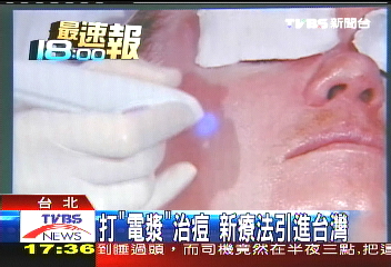 打「電漿」治痘　新療法引進台灣