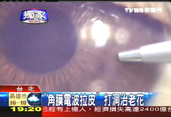 〈獨家〉「角膜電波拉皮」 打洞治老花