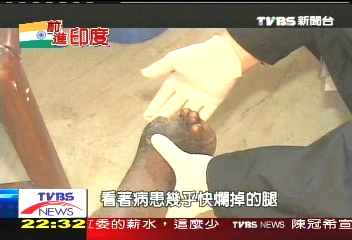 【前進新印度】印度起飛問題現 醫療城鄉差距大