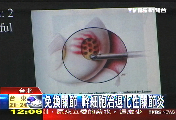 免換關節 幹細胞治退化性關節炎