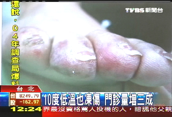 10度低溫也凍傷 門診量增3成