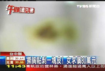 撕胸貼剝一塊皮! 女求償80萬元