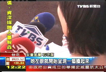 戴角膜塑形片　女童眼內碎裂險瞎