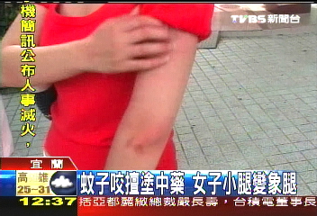 蚊子咬擅塗中藥　女子小腿變象腿
